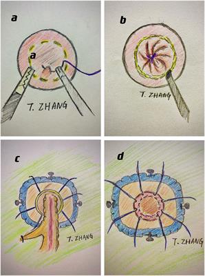 Clinical Status and Future Prospects of Transanal Total Mesorectal Excision